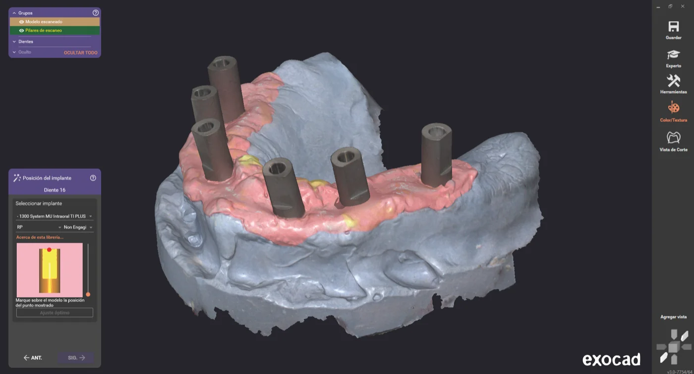 Scanbodies on a digital model